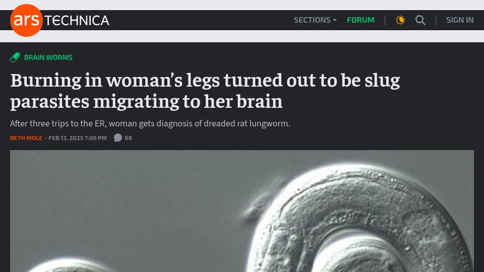 Screenshot of arstechnica.com: Burning in woman's legs turned out to be slug parasites migrating to her brain