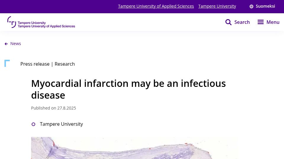 Screenshot of tuni.fi: Myocardial infarction may be an infectious disease