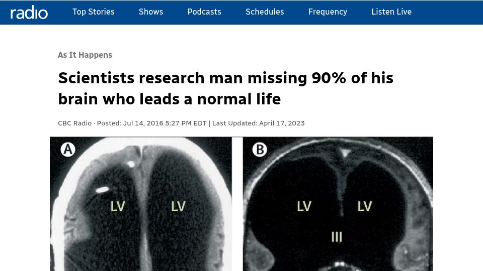Screenshot of cbc.ca: Scientists research man missing 90% of his brain who leads a normal life (2016)