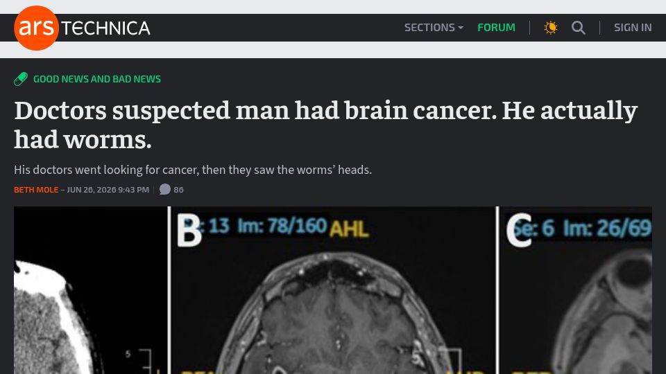 Screenshot of arstechnica.com: Doctors suspected man had brain cancer. He had worms